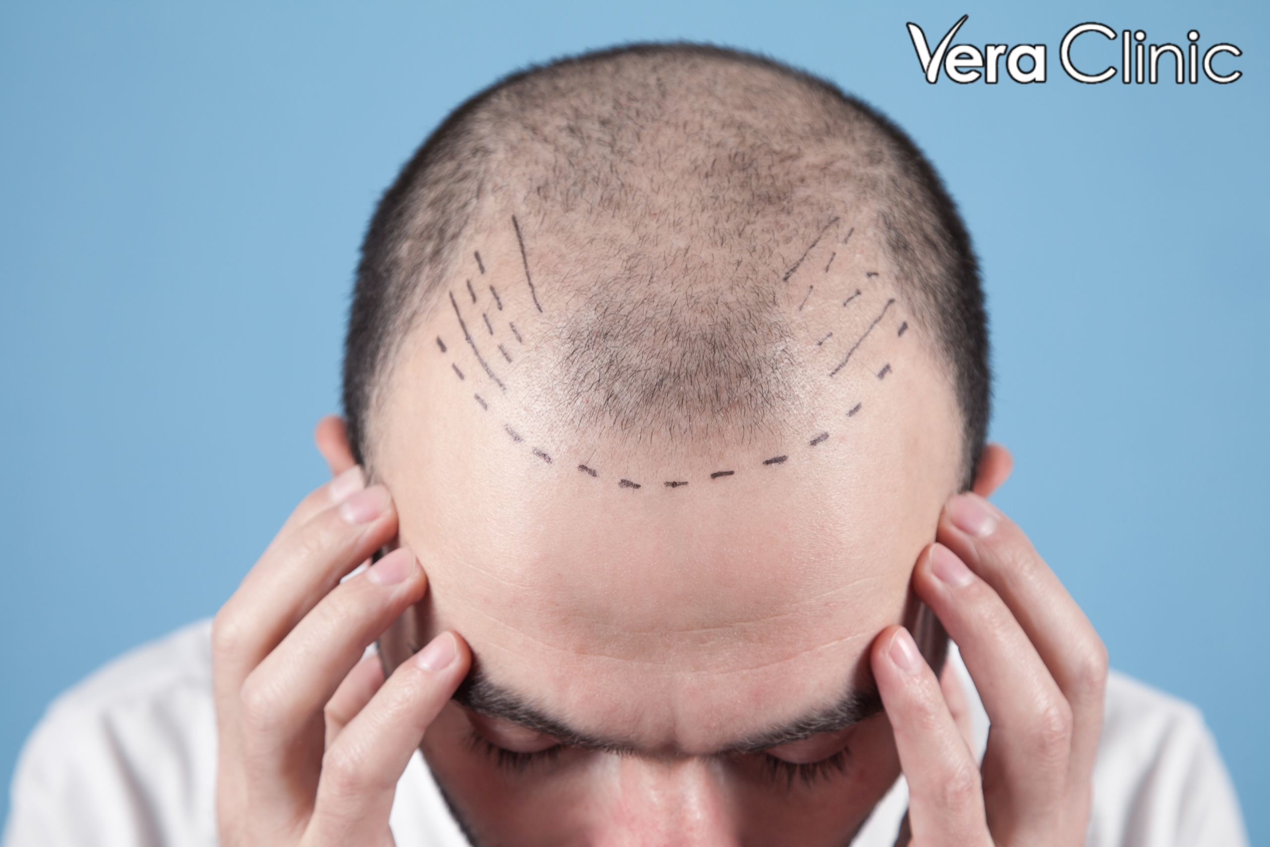 turkish hair transplant